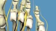 Morton's neuroma