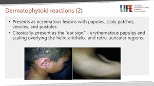 Tinea capitis (part 2/2)