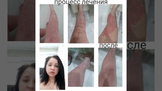 Вылечила ПСОРИАЗ