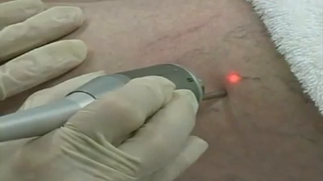 Código Médico Venas Varicosas смотреть онлайн