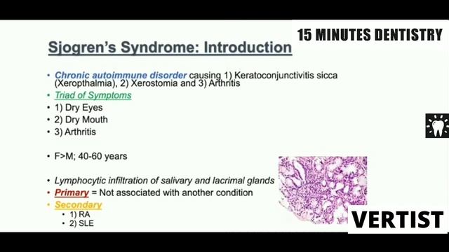 Diagnosis & Treatment of Dental Sialolithiasis | Sjogren Syndrome | Submandibular & Parotid