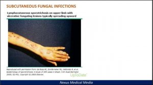 SUBCUTANEOUS FUNGAL INFECTIONS