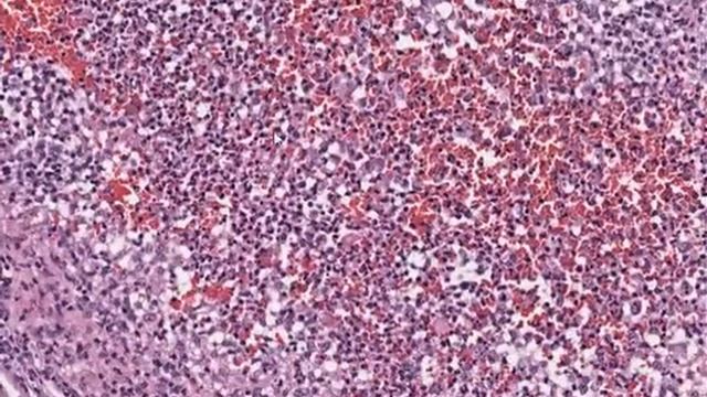 Sporotrichosis смотреть онлайн