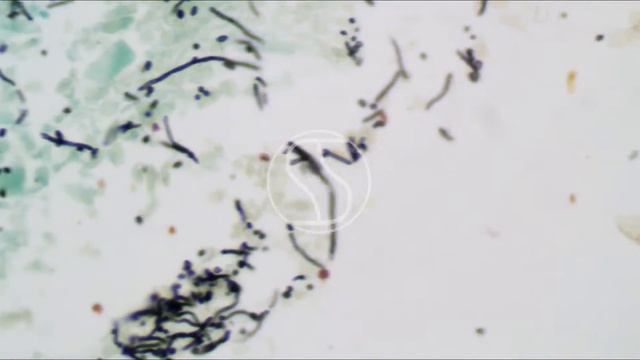 Candida under the microscope with Gomori's Methenamine Silver (GMS) stain смотреть онлайн