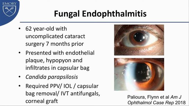 SYM54 08   Recent Advances in the Diagnosis and Management of Endophthalmitis   Role of Uncommon In