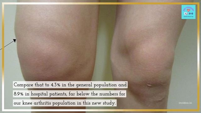 Nail Fungus and Arthritis: Weird Connection смотреть онлайн