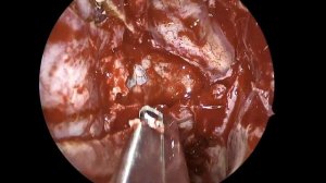 Endoscopic pituitary surgery: transsphenoidal approach