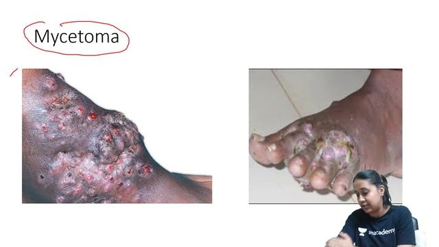 FMGE Dermatology Recall Question for Today | NEET PG 2021 | Dr. Chesta Agarwal смотреть онлайн