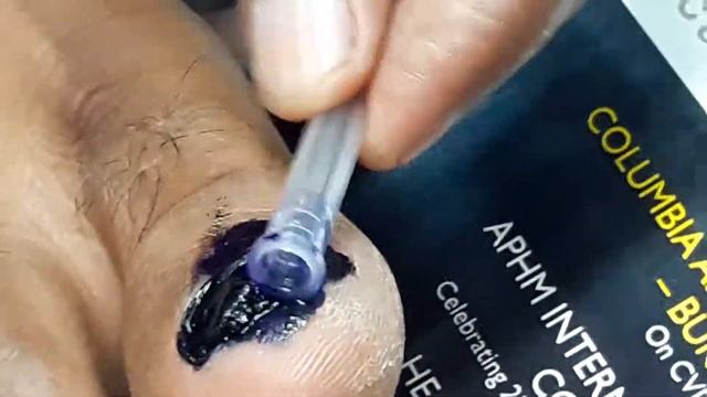 Onychomycosis+All fungi. Gentamicin28Omg Kenacort20mg смотреть онлайн