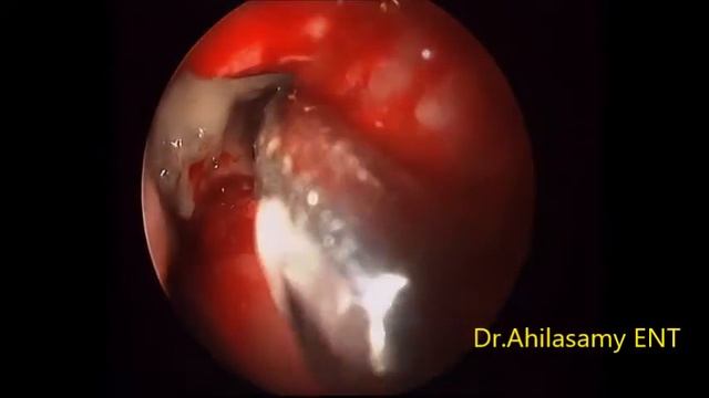 Mini FESS for (L) maxillary aspergilloma under LA смотреть онлайн