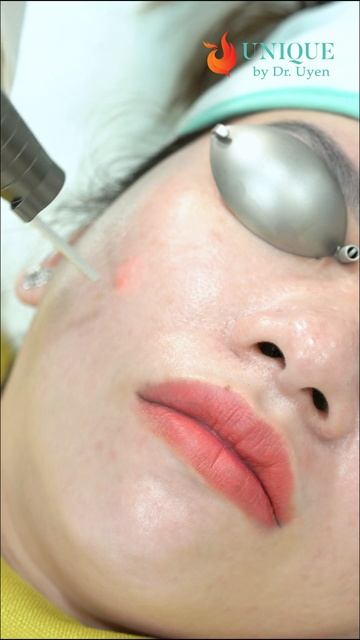 HLW toning - Laser Q4 điều trị nám mảng, nám chân sâu, tàn nhang, thâm mụn