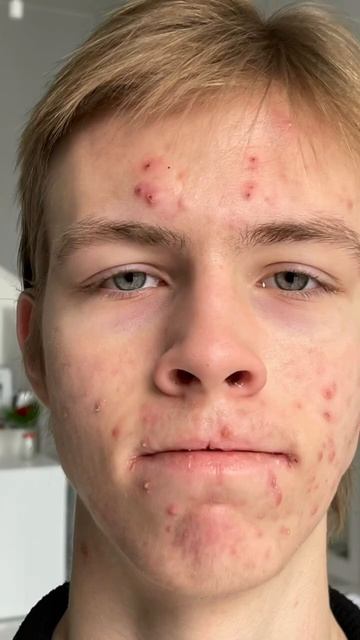 До/ после 🔥 #дерматолог #косметолог #врач #акне #кожа #красота #здоровье смотреть онлайн