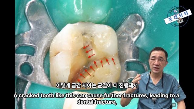 치아균열 크랙 치아를 충치로 오진하여 크라운 치료를 안받고 때우기만 하면?  crack tooth syndrome