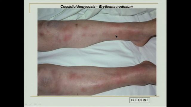 Coccidioidomycosis (Valley Fever) | Pediatric Grand Grounds - Mattel Children's Hospital UCLA смотреть онлайн