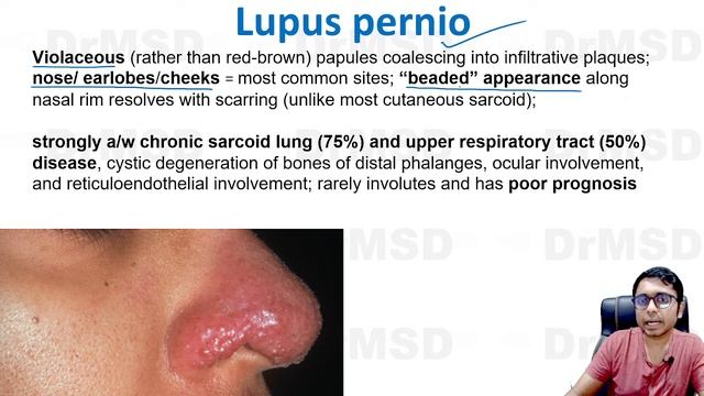 Sarcoidosis | Apple Jelly Nodules | Acne | LUPUS PERNIO | Vulgaris | Bilateral Hilar Lymphadenopath