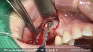 [DENTIS Implant] Posterior upper implant surgery with SQ fixture & lateral sinus lift