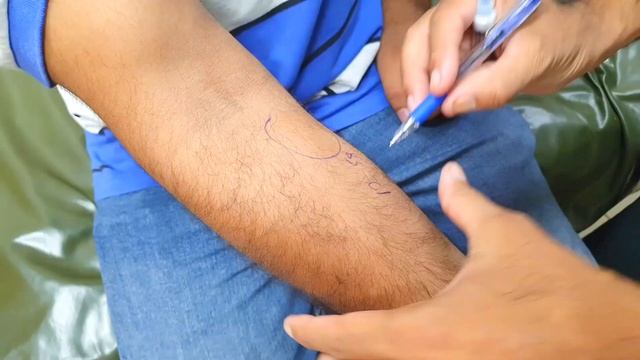 Penicillin G Allergy Test | Benzylpenicillin | Type 1 Hypersensitivity Reaction | How to Do