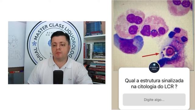 Cryptococcus Neoformans sinalizado na citologia do Líquido Cefalorraquiano смотреть онлайн