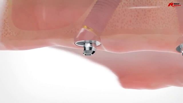 All-on-4® имплантация все на 4 Nobel Biocare