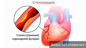 стенокардия
