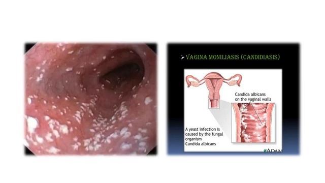 Lower genital tract infection PART 2 смотреть онлайн