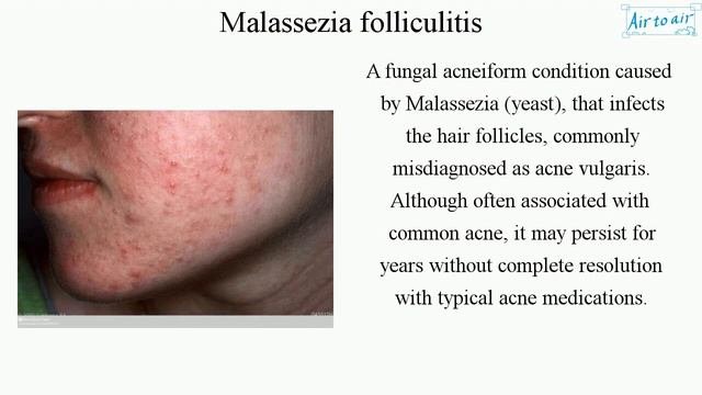 Malassezia Folliculitis