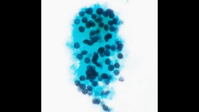 Cytological diagnosis of Pneumocystis jiroveci carinii pneumonia