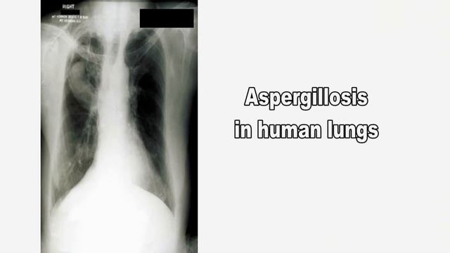 Aspergillus and Aspergillosis смотреть онлайн