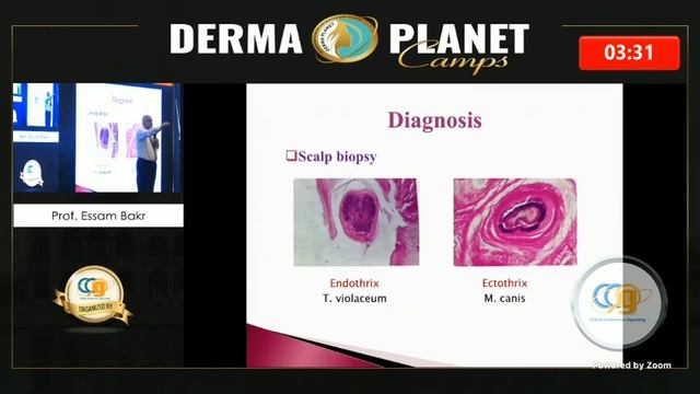 Tinea capitis in adults by Dr Essam Bakr смотреть онлайн