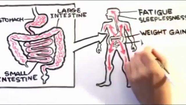 Sugar - cause of Candida - Candida cause of Cancer смотреть онлайн