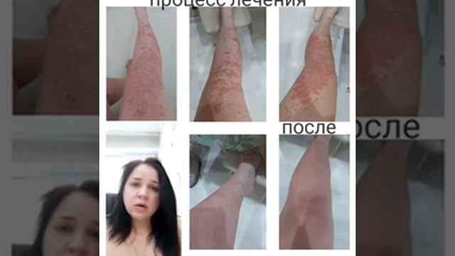 Псориаз излечим с продуктами LR