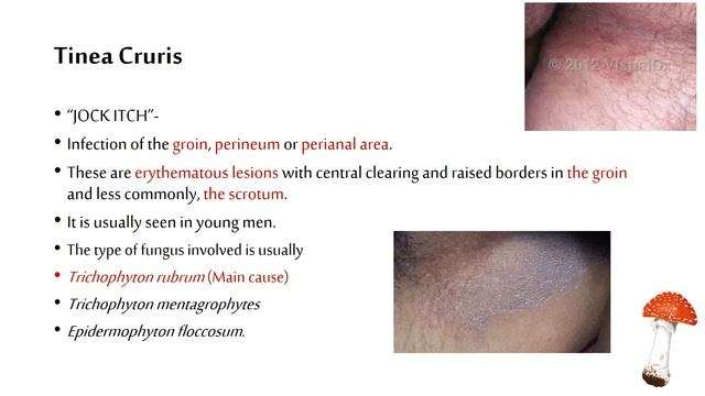 Medical Mycology, Cutaneous Mycosis смотреть онлайн