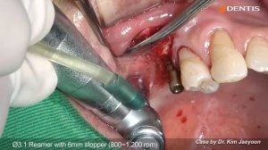 [DENTIS Implant] Upper posterior implant placement with crestal sinus lift