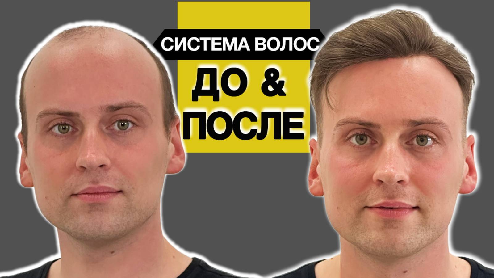 Жизнь в системе волос несколько лет, заметно ли? Ассортимент систем волос при алопеции у мужчин