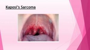 Mononucleosis, Pneumocystis, Kaposi's Sarcoma