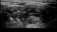 Scalene Injection of Botox for Thoracic Outlet Syndrome-Arun Kalava MD FASA EDRA