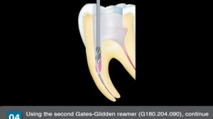 Step-by-Step: Using Komet's Endo Rescue Kit 4601 for removing instrument fragments