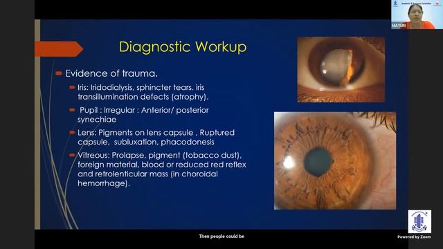 Update series on Ocular Trauma   DR  MAYURI B KHAMAR смотреть онлайн
