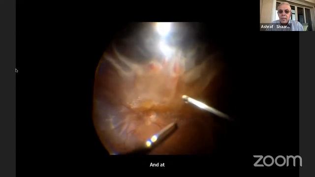 HALL B - PAN OPHTHALMOLOGICA 2023 смотреть онлайн