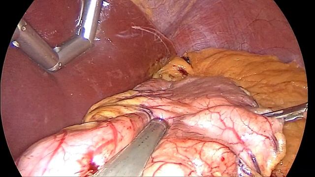 Морбидное ожирение. Рукавная резекция желудка. Sleeve gastrectomy.