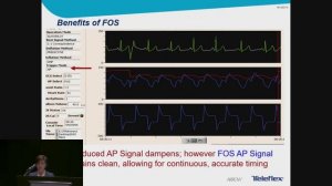 The Challenge of Timing during Arrhythmia: Implementation of New Real Time Methods