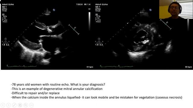Mitral stenosis смотреть онлайн