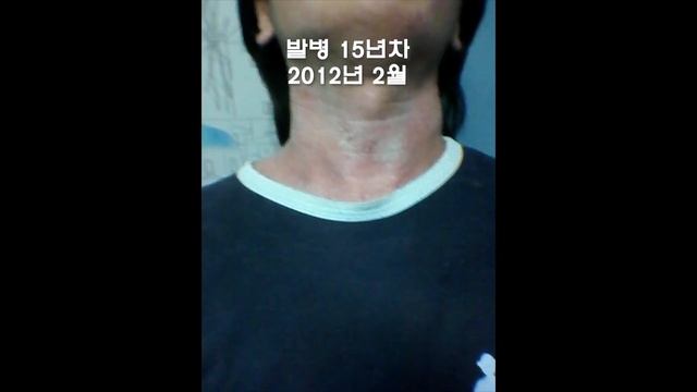 만성 성인 아토피피부염 치료 과정 !! 반마의 백 퍼센트 리얼스토리 (+ 여드름, 지루성 피부염 등. 비교 사진 수 백장 대공개) смотреть онлайн