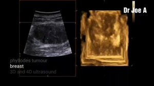 Phyllodes tumour breast 3D and 4D ultrasound