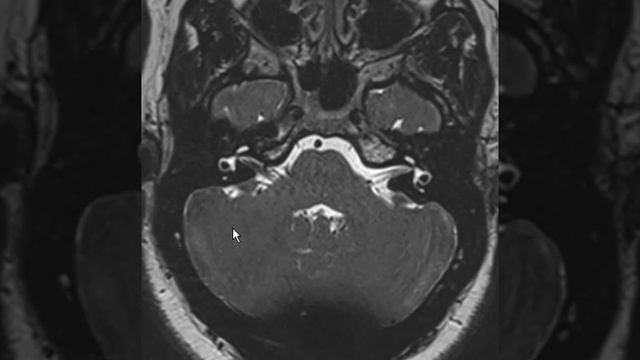 Vascular Loop in IAC смотреть онлайн