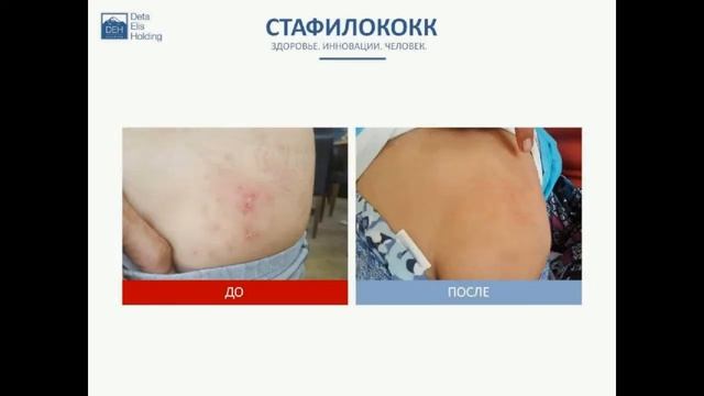 Результаты оздоровления. Биорезонанс.