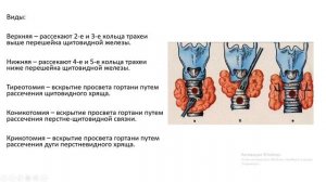 Трахеостомия. Показания. Виды и этапы операции. Осложнения.