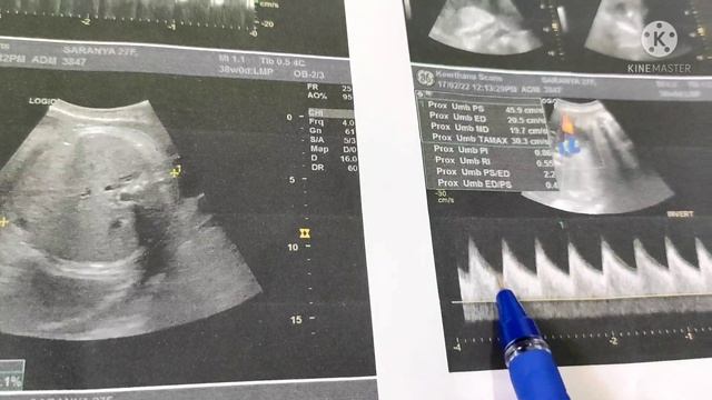 gender predict using Scan Reports in tamil/ how to find boy or girl scan report/ramsaran channel смотреть онлайн