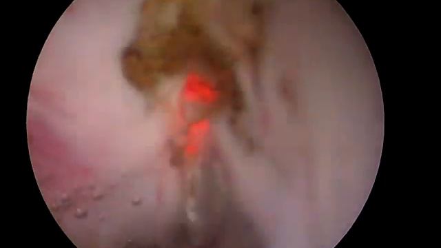 BPH Diode Laser Enucleation BY DR SANJAY KHADGI смотреть онлайн