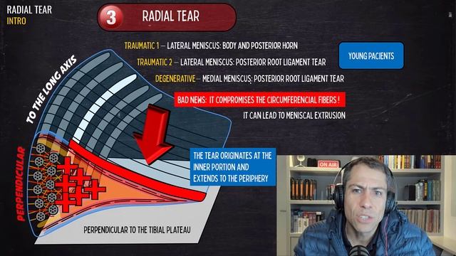 Radial Meniscal Tear on MRI (Part 1)